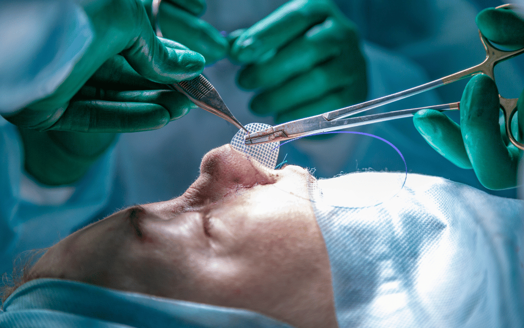 Affordable nose reshaping alternatives